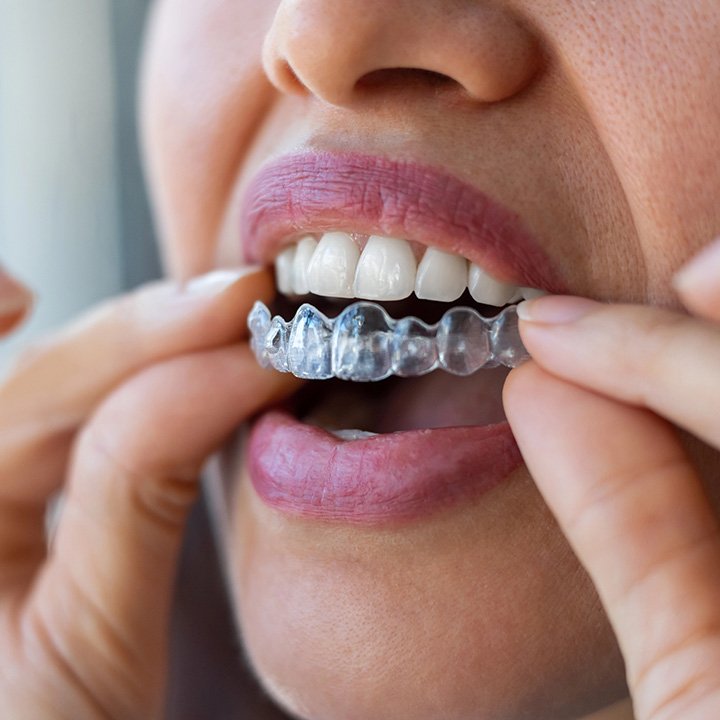 Woman using Invisalign clear aligners to straighten her teeth