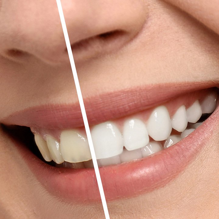 Before and after results of teeth whitening treatment in Stafford, VA