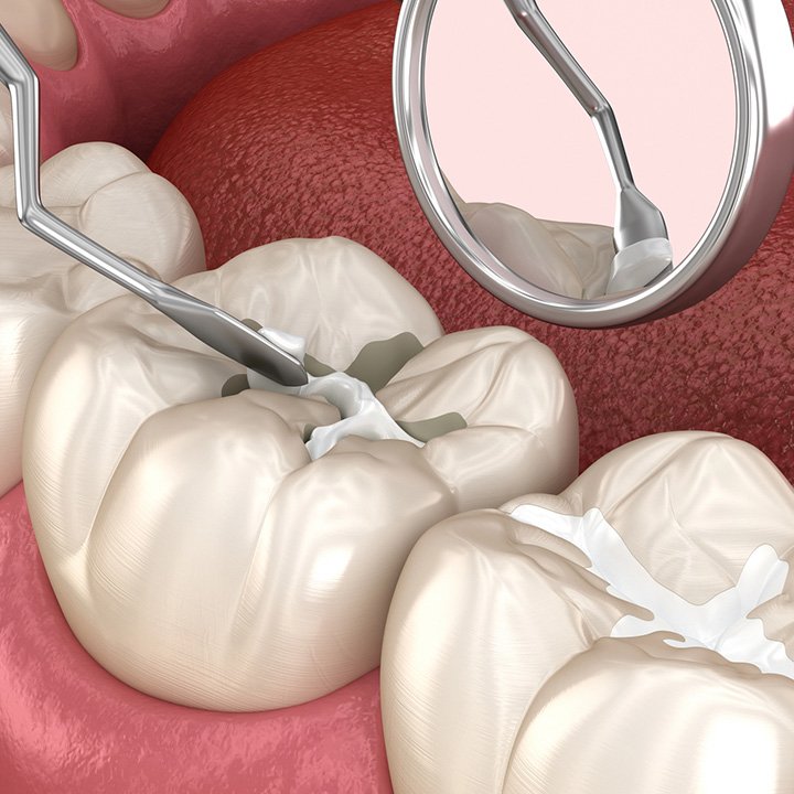 Dental sealants procedure for cavity prevention in Stafford, VA