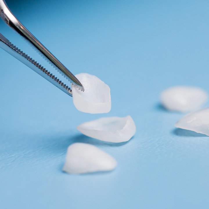 Porcelain veneers for teeth enhancement in Stafford, VA